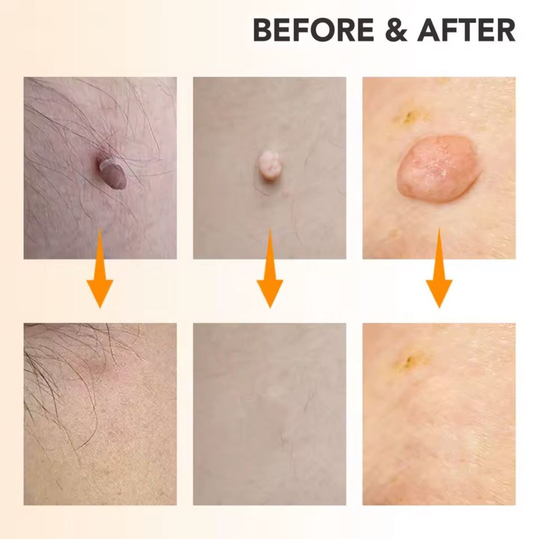 DermaFix | Complete Skin-Tag Remover Kit