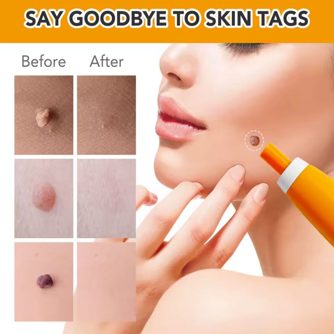 DermaFix | Complete Skin-Tag Remover Kit