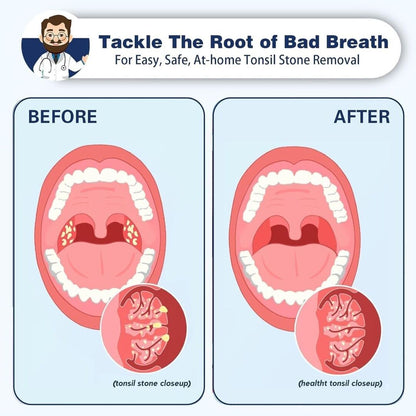 BreatheClear | Zeg Vaarwel tegen Amandelstenen & Mondgeur